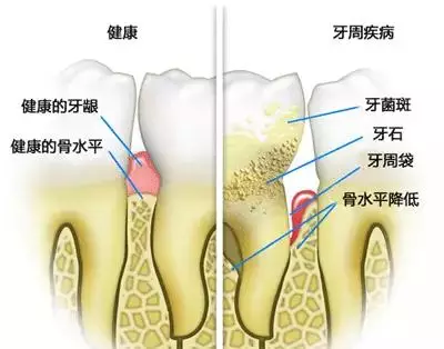 韦东奕牙周炎治疗启示：跨界健康创新之道